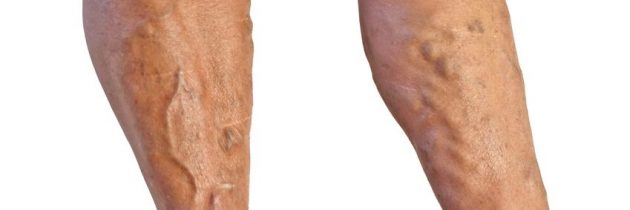 Varicose Veins? Endovenous Laser Ablation in Schaumburg IL Will Help You