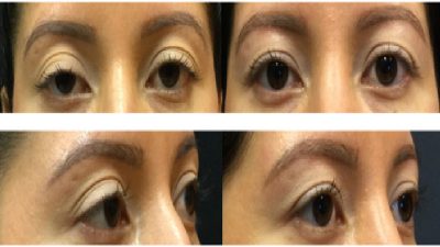 Blepharoplasty in Minneapolis, MN, Can Make a Big Difference