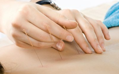 Acupuncture Therapy In Newark CA For Stress Relief And Holistic Wellness Solutions