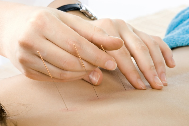 Acupuncture Therapy In Newark CA For Stress Relief And Holistic Wellness Solutions