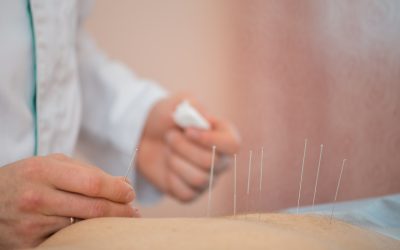 Experience Relief with Acupuncture Fort Lupton CO’s Natural Healing Touch