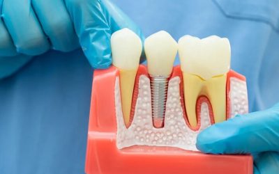 Enhance Your Smile with Cosmetic Dental Bonding in Burlington, NC