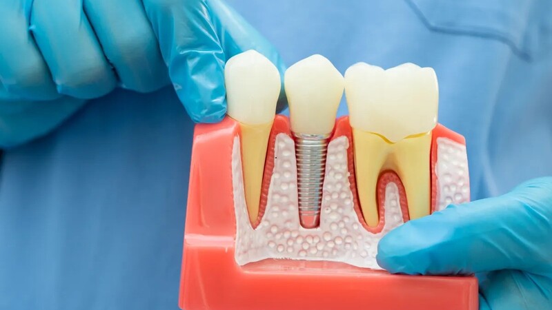 Enhance Your Smile with Cosmetic Dental Bonding in Burlington, NC