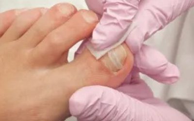Top Causes of Ingrown Toenails and How to Prevent Them