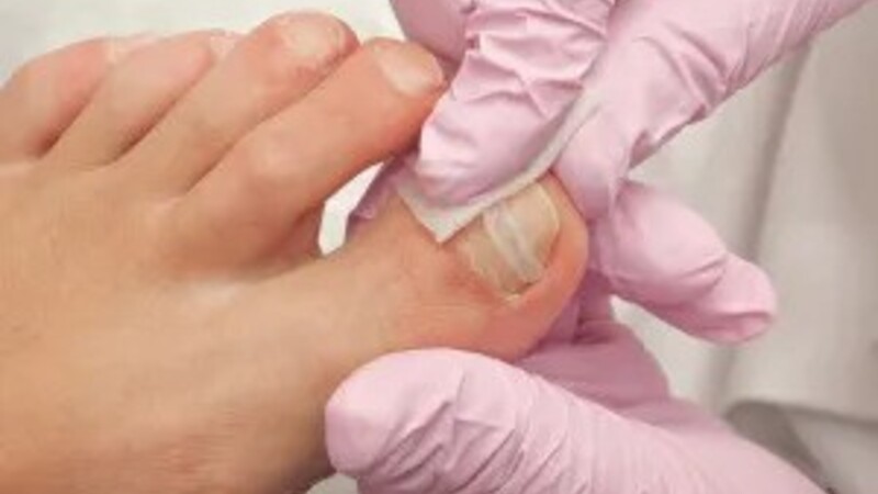 Top Causes of Ingrown Toenails and How to Prevent Them