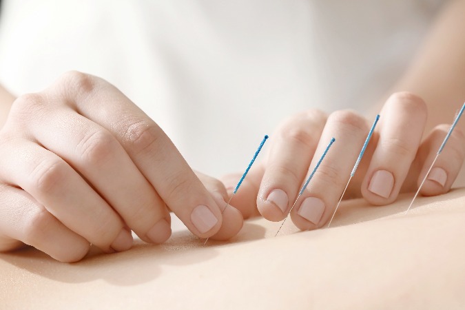 Experience Lasting Relief with Acupuncture For Pain Management In Berkeley, CA Solutions That Work