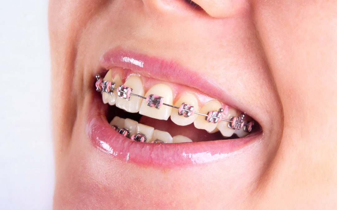 Achieve Your Dream Smile Through Advanced Orthodontics in Kennewick