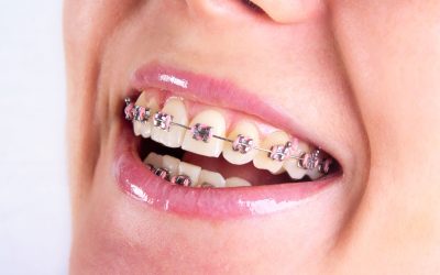 Achieve Your Dream Smile Through Advanced Orthodontics in Kennewick