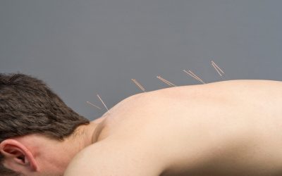 Find Lasting Relief from Stress Using Acupuncture In Sudden Valley, WA, Treatments Near You